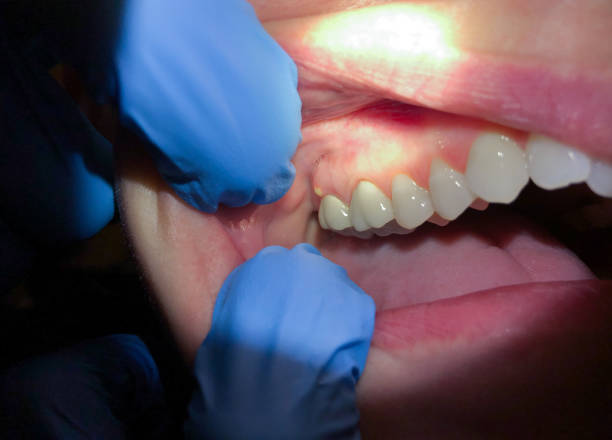 Best Emergency Treatment for Dental Infections or Abscesses in Kings Park, VA
