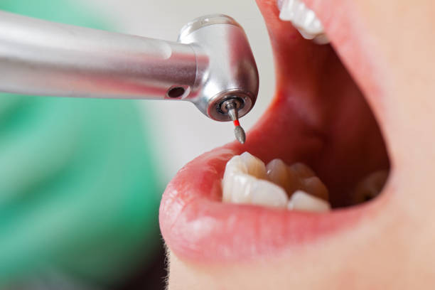 Best Emergency Root Canal Treatment in Kings Park, VA